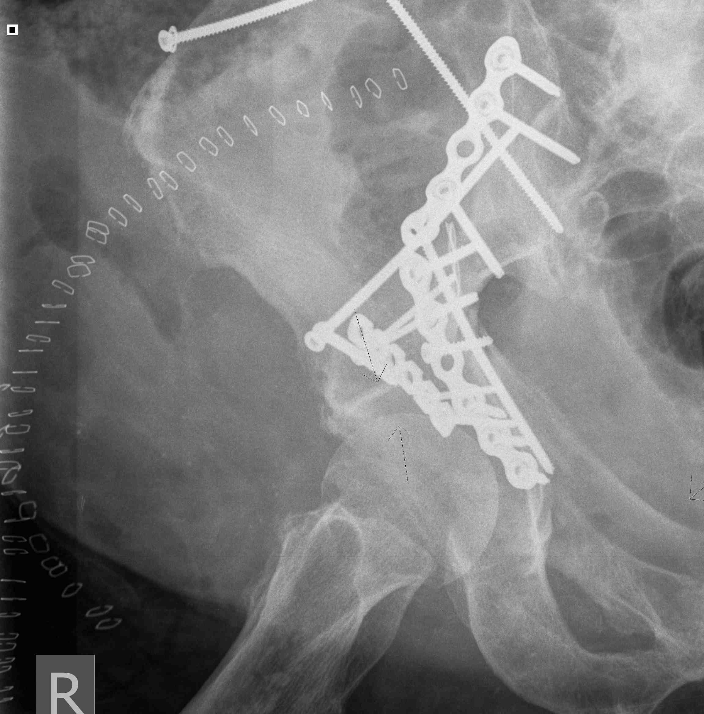 Triradiate approach Both Column Fracture